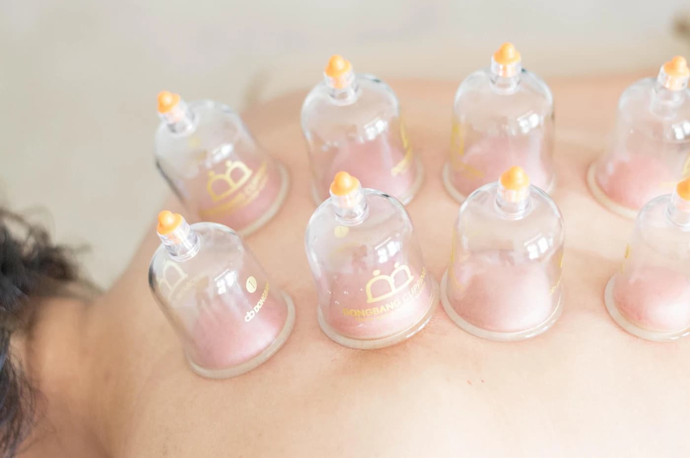 Pose de ventouses thérapeutiques sur le dos — décongestion des méridiens et soulagement des douleurs